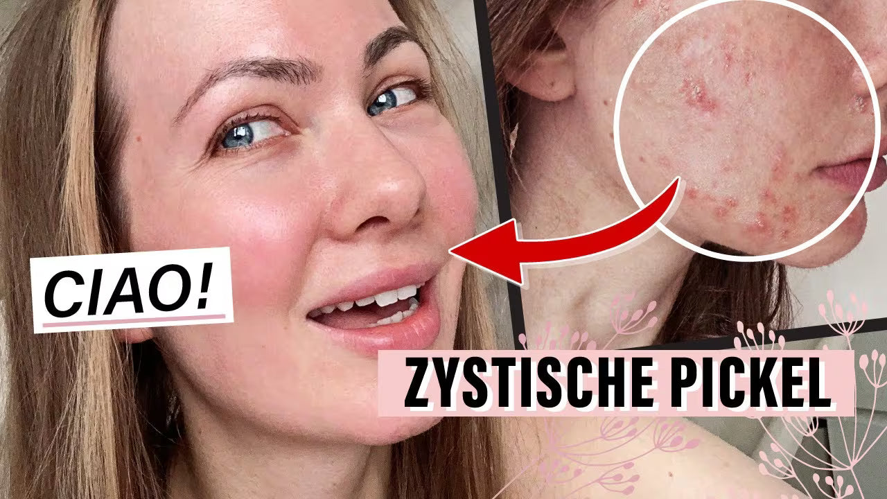 Unterirdische Pickel SCHNELL loswerden  | Vorher & Nachher Ergebnisse   HAUTTIEF