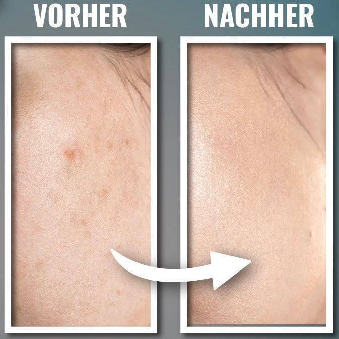 Schnell Pigmentflecken entfernen