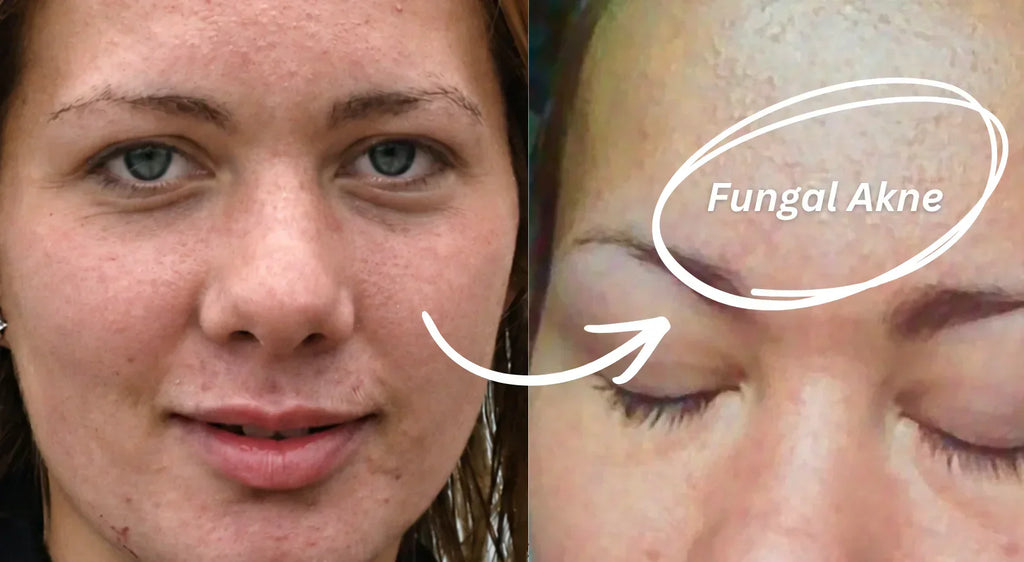 Was triggert Fungal Akne wirklich? Alle Auslöser erklärt