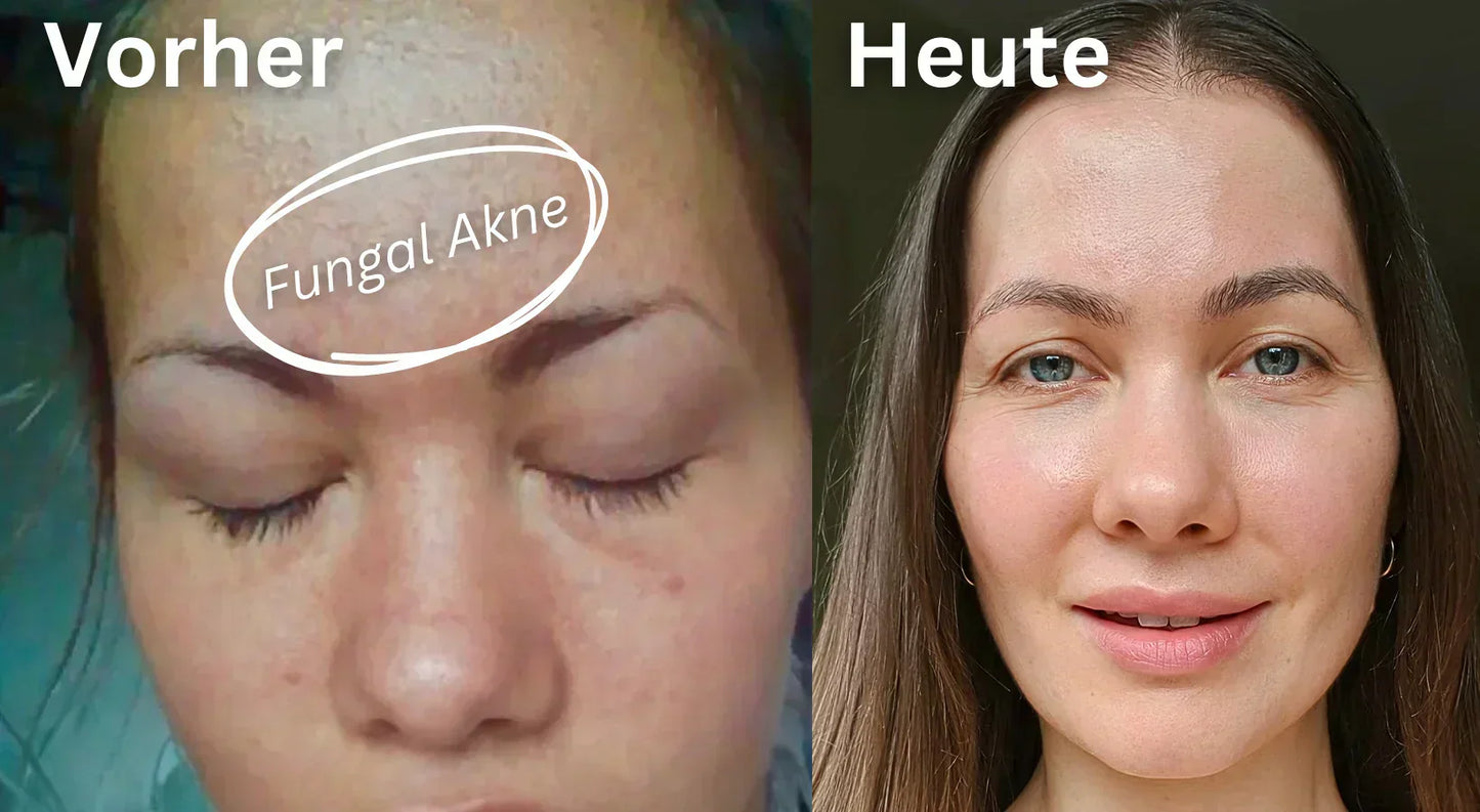 Fungal Akne loswerden: Vorher-Nachher Vergleich einer Malassezia Follikulitis mit deutlich reinerer Haut nach der Behandlung.