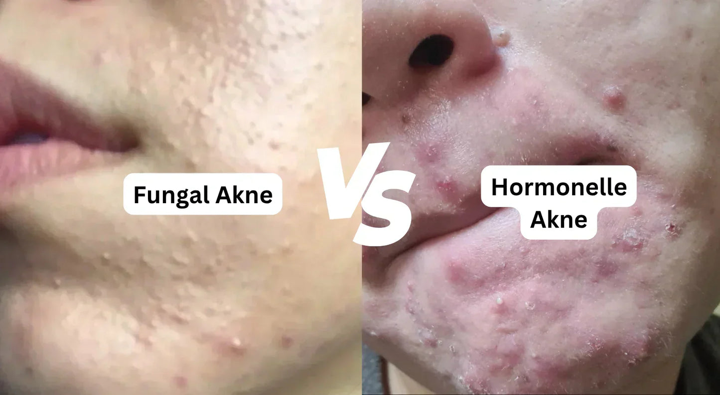 Unterschied Fungal Akne und hormonelle Akne im direkten Vergleich mit gleichförmigen Mini-Pickeln und entzündlichen Pickeln im Kinnbereich.