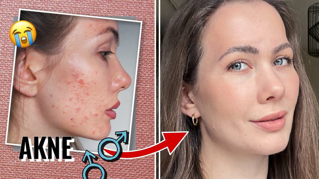 Hormonelle Akne erfolgreich behandeln