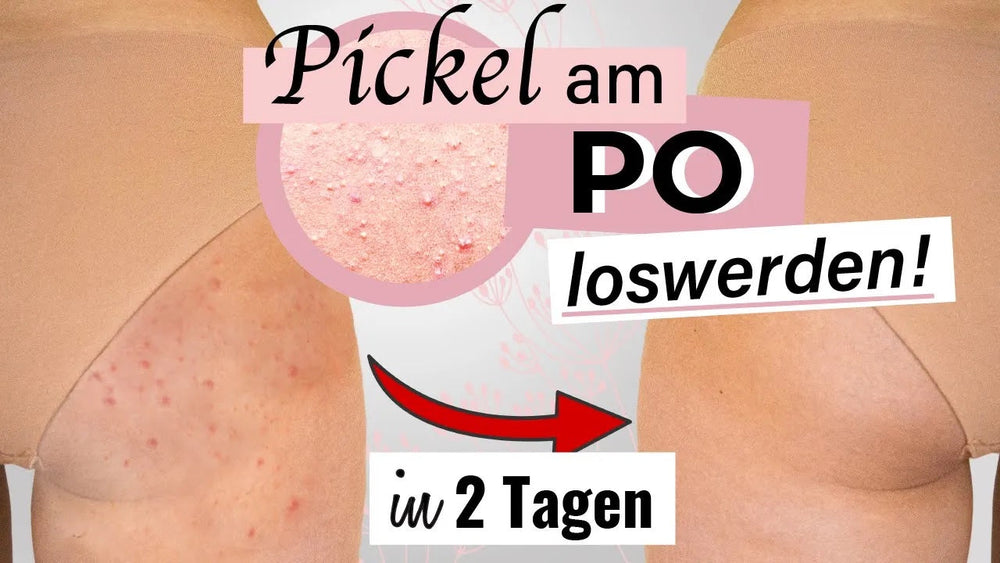 Pickel Akne am Po loswerden als Frau