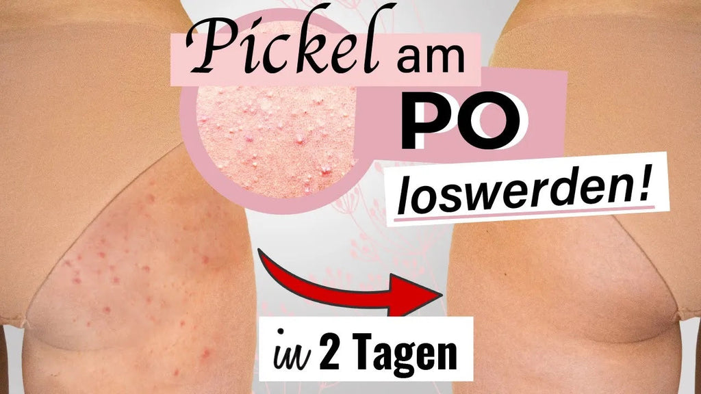 Pickel & Akne am Po schnell loswerden
