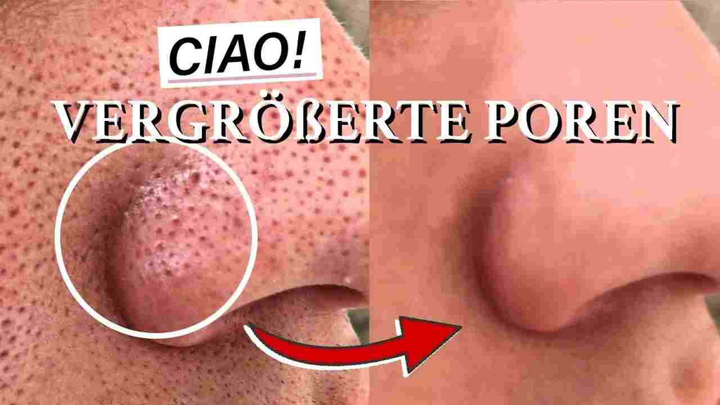 Große Poren schnell entfernen