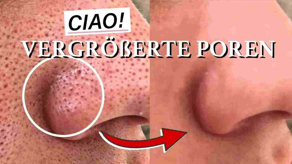 große Poren schnell entfernen