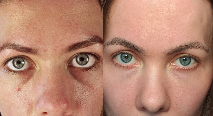 HAUTTIEF Blog, Blogbeitrage, fettige Haut loswerden, fettige Haut vorher nachher, Hautpflege bei fettiger Haut, glänzende Haut reduzieren, große Poren verkleinern, Haut mattieren, Pickel durch fettige Haut, unreine Haut vorher nachher, Anti-Glanz Hautpfle