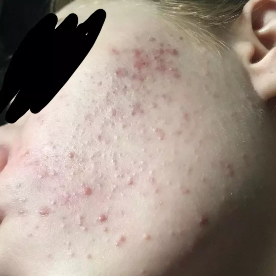 fungal akne acne malassezia loswerden mini pickel kinn stirn rücken dekollete blogbeitrag oberarme
