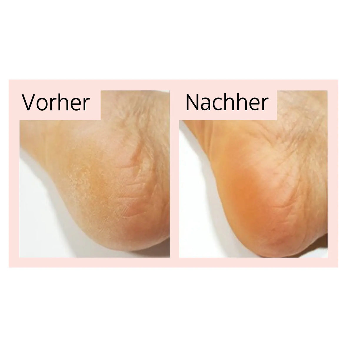 ESFOLIO Foot & Heel Peeling Mask HAUTTIEF