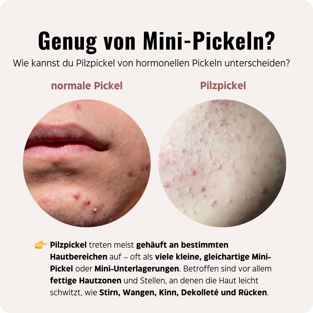 
                      
                        🍄 Mini-Pickel & Unterlagerungen Set
                      
                    